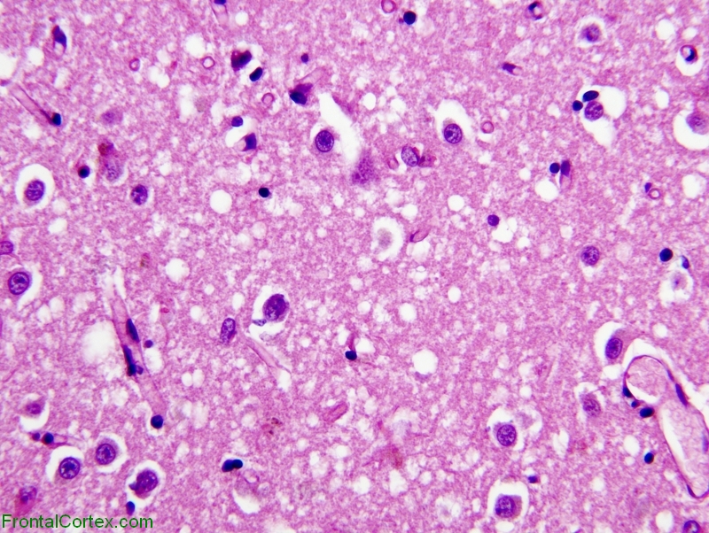 Sporadic Jakob-Creutzfeldt disease, corpus striatal, H&E stain x 200