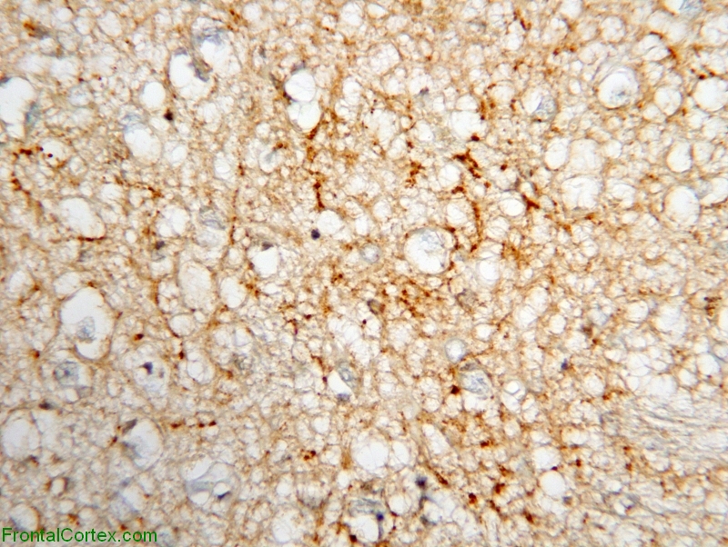 Sporadic JCD, corpus striatum, 3F4 immunohistochemical staining