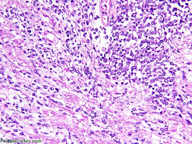 Lymphoma peripheral nerve root, 200x