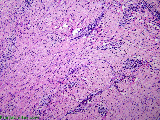 Neurofibroma