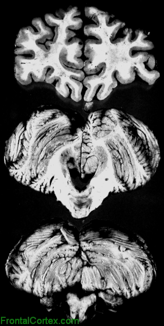 Olivopontocerebellar Atrophy, coronal section through frontal lobe and transverse sections through pons, medulla, and cerebellum.