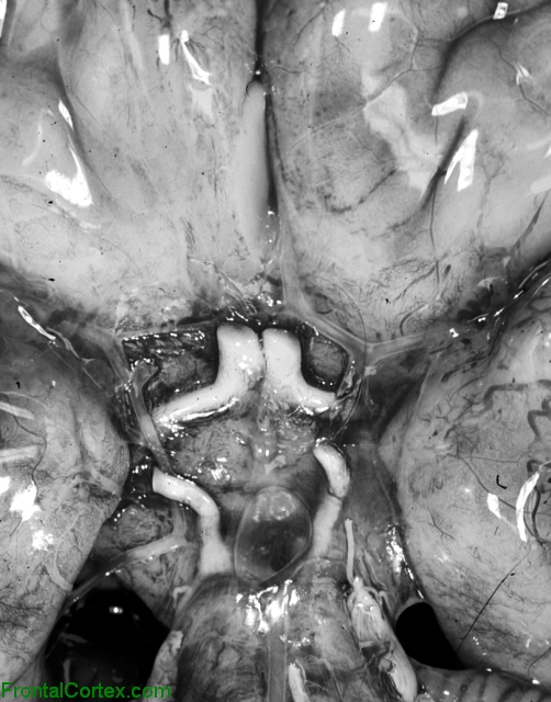 Isolated arhinencephaly, ventral surface of brain