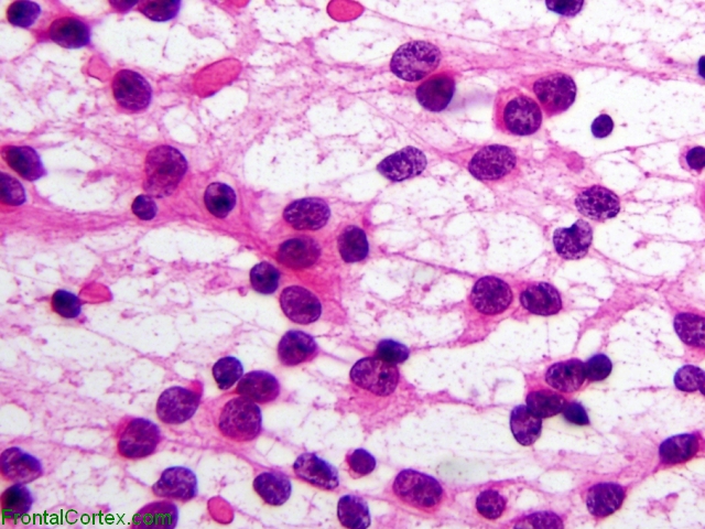 Oligodendroglioma,   Intraoperative smear preparation x 200