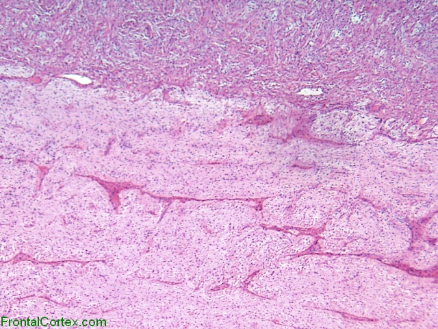 Pilocytic astrocytoma of optic nerve, with extension into optic nerve sheath, H&E stain x 40