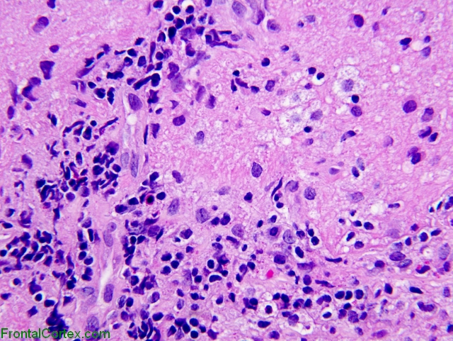 Optic Neuritis, H&E stain x400