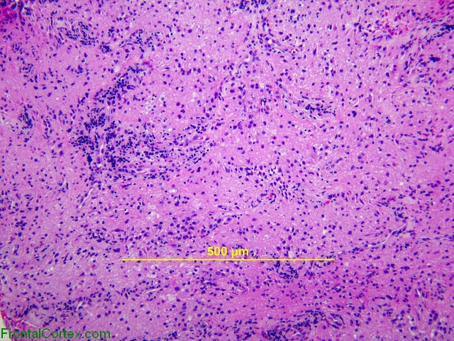 Optic Neuritis, H&E stain x100