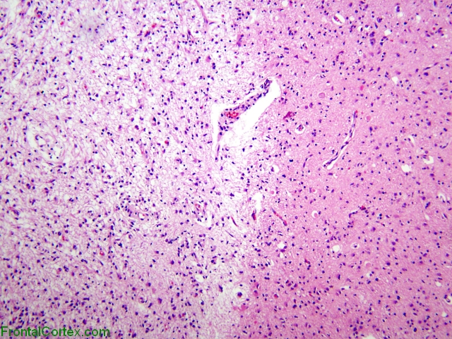 Hypotensive brainstem necrosis, organizing phase, H&E stain