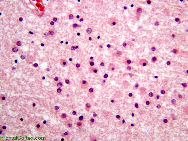 Organizing periventricular leukomalacia, high power H&E stain