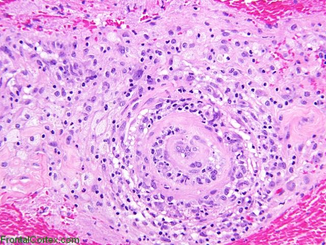 Primary angiitis of the central nervous system, leptomeningeal blood vessel, high power H&E