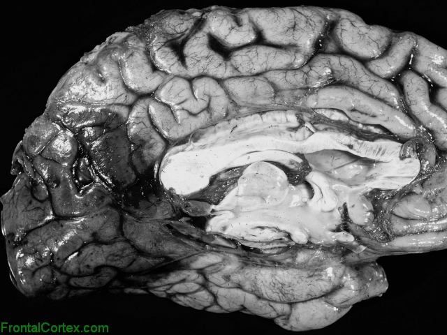 Posterior Cerebral Artery. Posterior cerebral artery