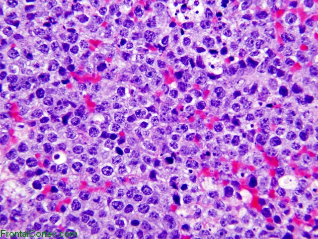 Primary central nervous system lymphoma, H&E stain x 200