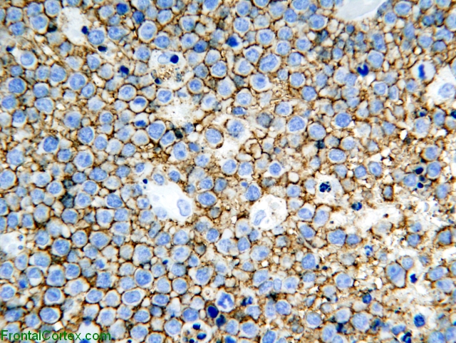 Primary central nervous system lymphoma, CD20 immunohistochemical staining