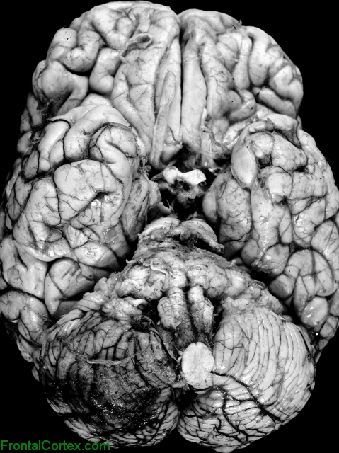 Brain Inferior Surface