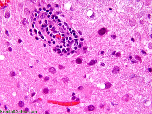 Progressive multifocal leukoencephalopathy, H&E stained section x 200