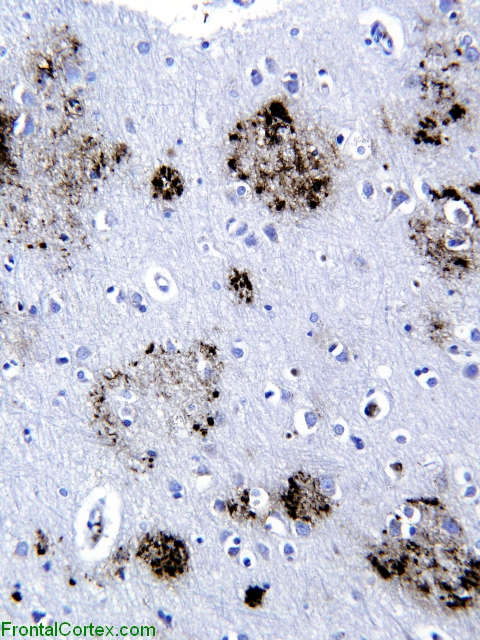 PS1 familial Alzheimer disease, beta amyloid immunohistochemical stain, neocortex.