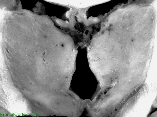 PSP Coronal Subthalamic