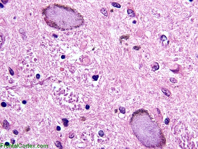 PSP Globose NFT Substantia Nigra H&E