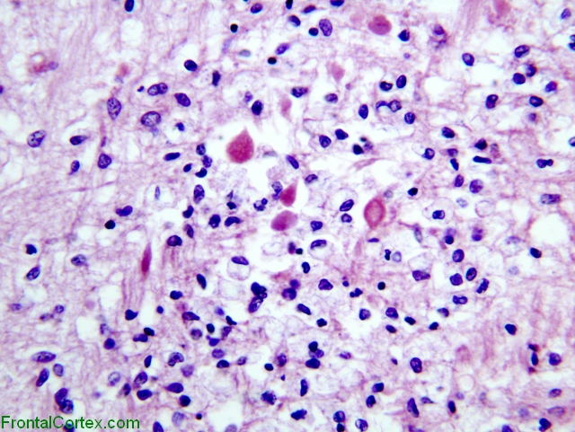 Organizing periventricular leukomalacia