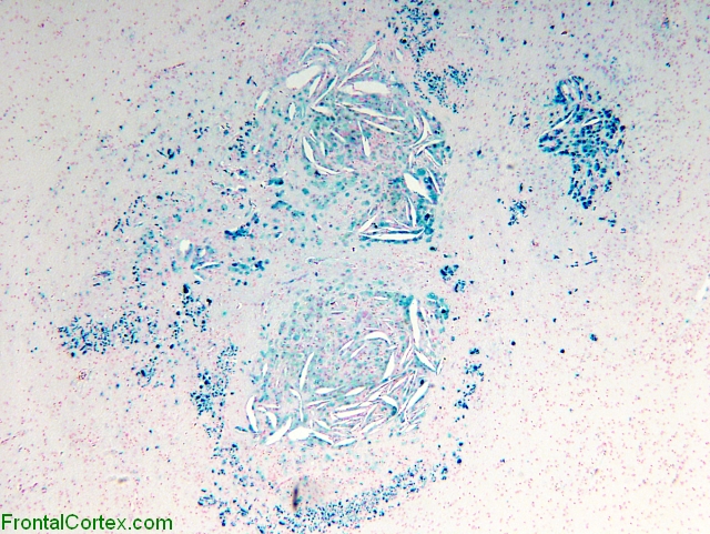 Periventricular leukomalacia with organized hemorrhage, Berlin blue stain for iron