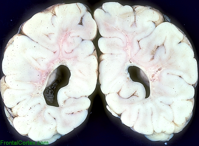 Periventricular leukomalacia, coronal