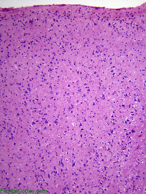 Focal cortical dysplasia, Palmini 1a, H&E stain