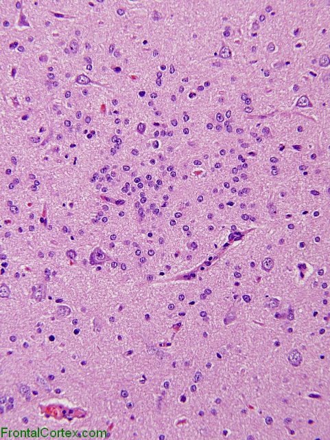 Focal cortical dysplasia, Palmini 1b, high power H&E stained section