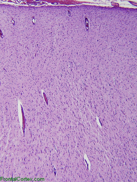 Focal cortical dysplasia, Palmini 2a, low power overview H&E stained section of cerebral cortex