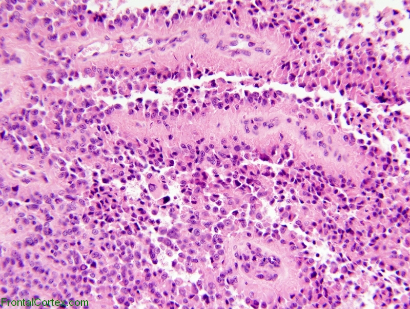 Papillary meningioma, high power H&E stained section.