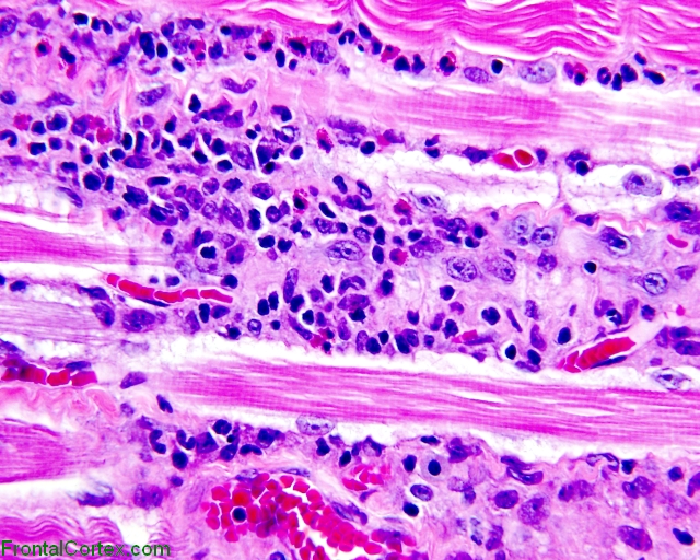 Dermatomyositis, H&E stained sections of paraffin embedded skeletal muscle