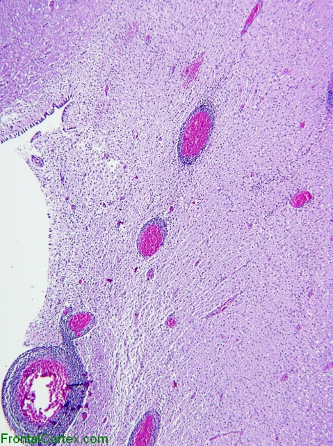 Active demyelinative plaque, periventricular region, H&E stain x 40