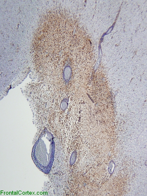 Active demyelinative plaque, periventricular region, CD68 immunohistochemical staining