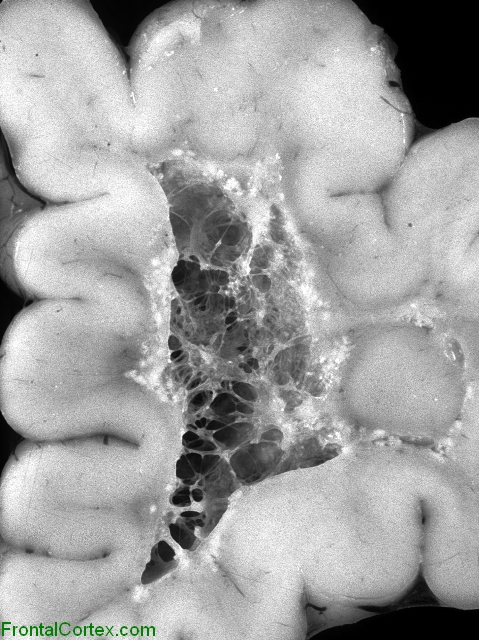 Periventricular leukomalaciawith advanced cavitation, right frontal lobe, coronal section.