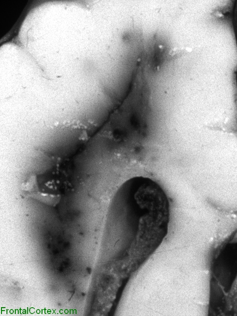 Periventricular leukomalacia with hemorrhagic transformation