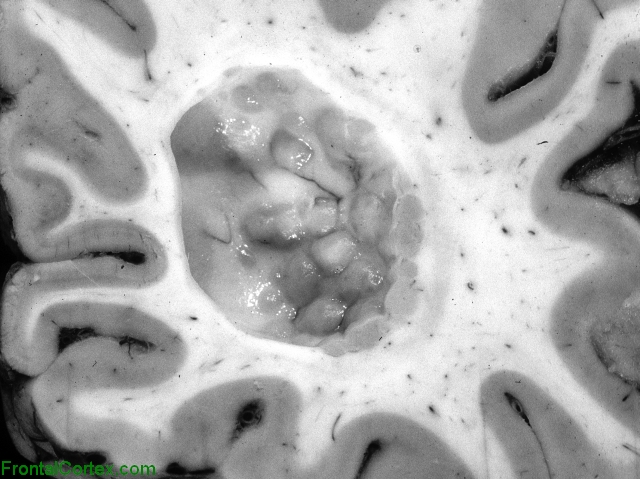 Periventricular nodular heterotopia, coronal section through occipital lobe of brain.