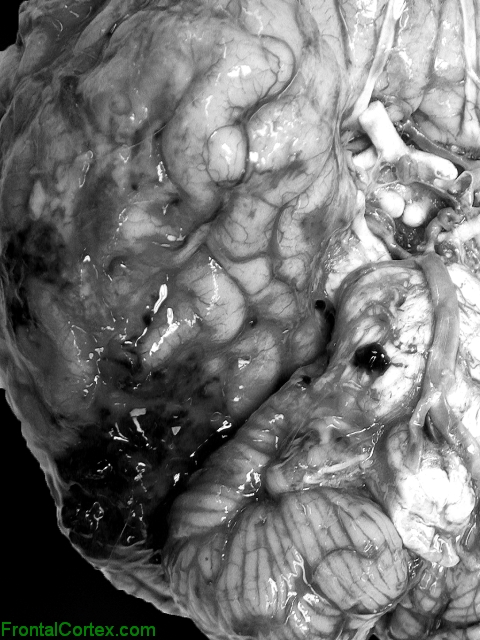 Phaeohyphomycosis, basal lateral surface of brain.