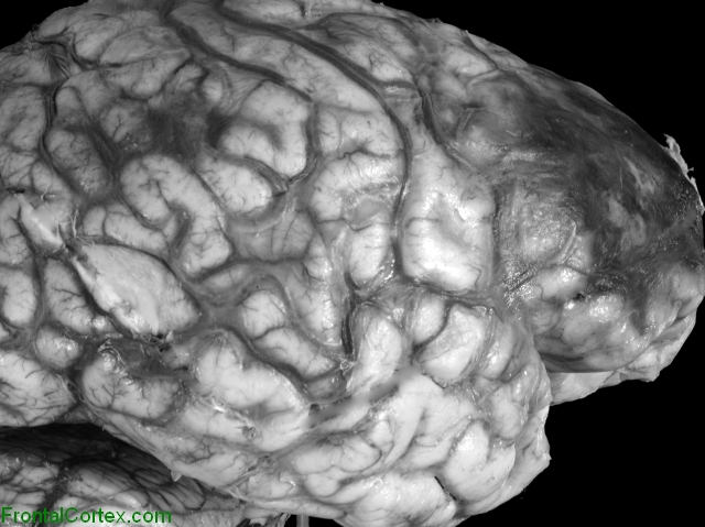 Phaeohyphomycosis, lateral surface of brain.