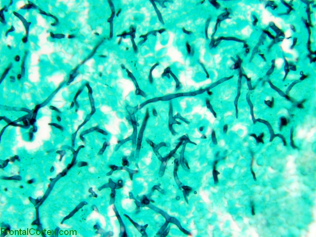 Phaeomycosis, Gomori methenamine Silver staining x 600