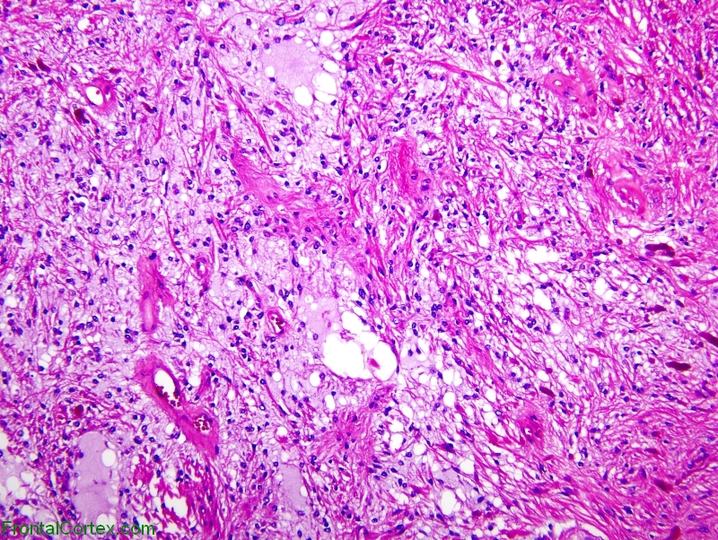 Pilocytic astrocytoma, H&E x 100