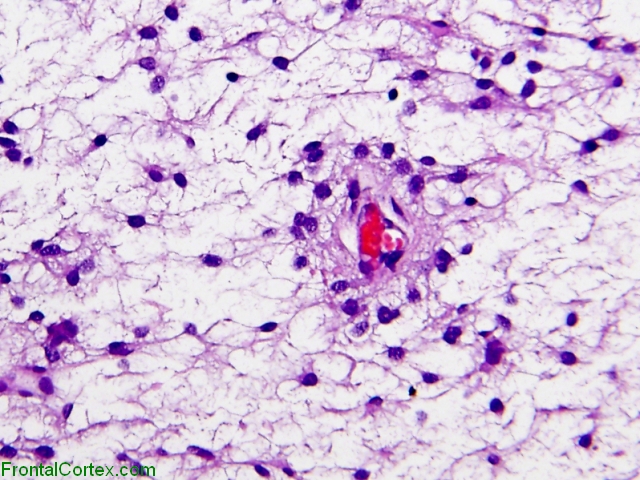 Pilomyxoid Astrocytoma, H&E stain x 200