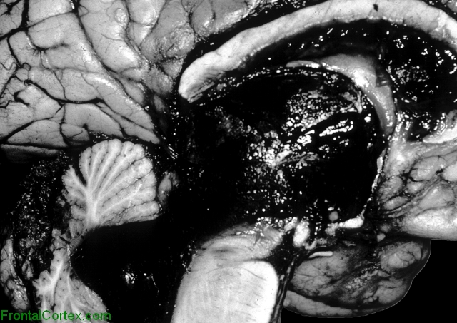 "Pineal apoplexy", mid sagittal section of brain.