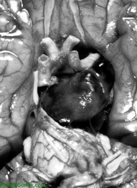 Pituitary Adenoma Ventral