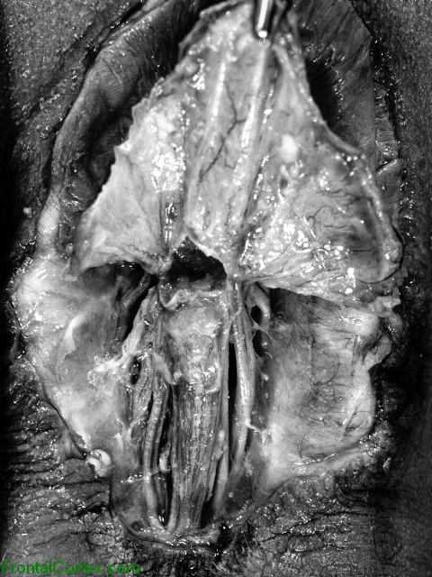 Meningomyelocele, dorsal surface of lower back