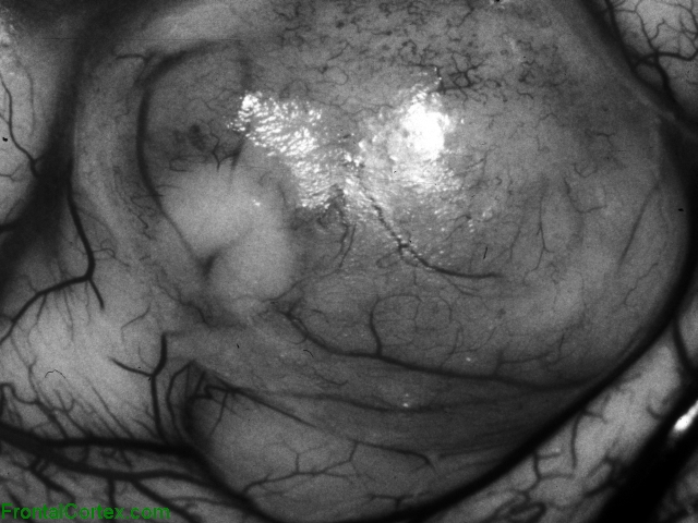 Pleomorphic Xanthoastrocytoma, Surgical Exposure