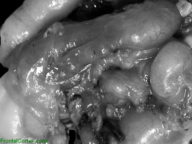 Plexiform Neurofibroma Surgical