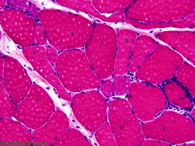 Polymyositis, H&E stained section