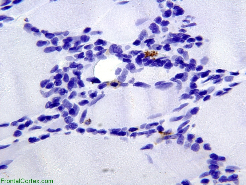 Polymyositis, CD20 immunohistochemical staining x600