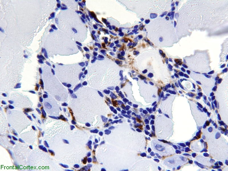 Polymyositis, immunohistochemical staining for CD68 x600