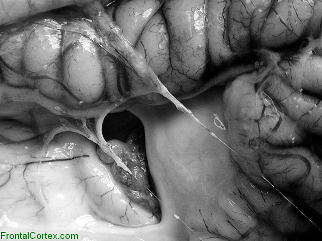 Porencephaly, right lateral surface of brain.