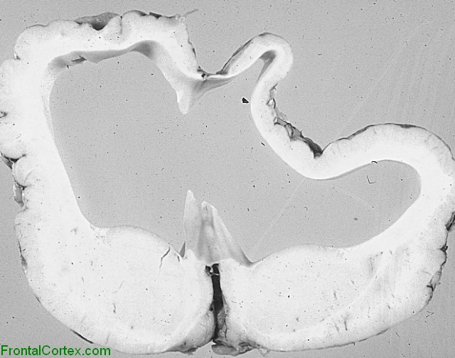 Severe post hemorrhagic hydrocephalus, coronal section through basal ganglia.