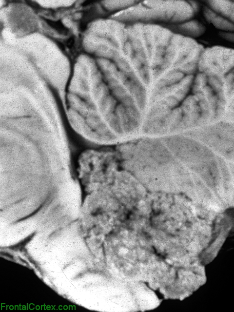 fourth ventricular ependymoma, sagittal section through brainstem and cerebellum.